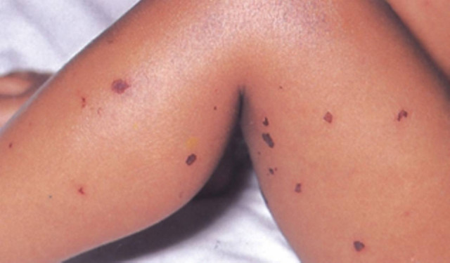 Κρούσμα μηνιγγίτιδας σε 14χρονο στο Λουτρό Αμφιλοχίας