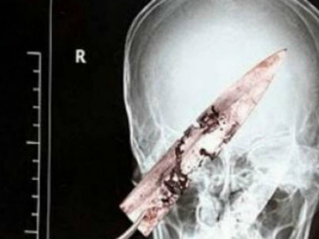 Απίστευτο: Ζούσε για 4 χρόνια με ένα μαχαίρι στο κεφάλι!