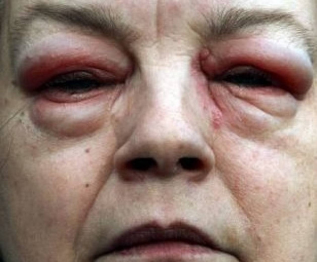 Απίστευτο: Έβαλε σταγόνες και λόγω αλλεργίας έγινε σαν... εξωγήινη!