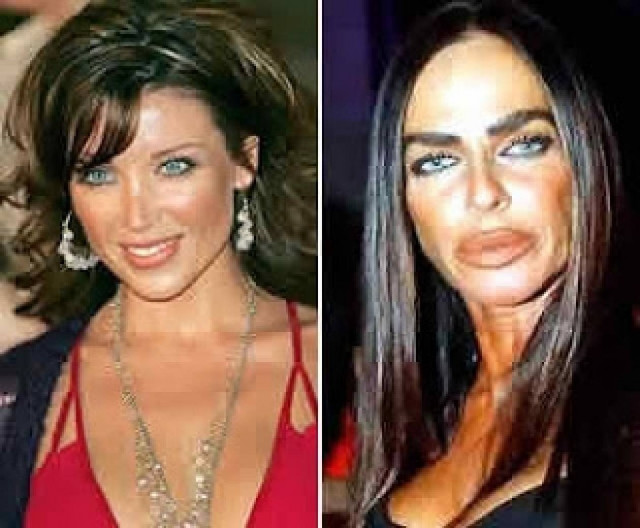 ΣΟΚ: Δείτε πως έγιναν με τις ενέσεις σιλικόνης (pics)