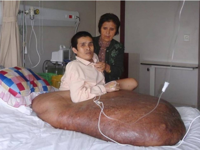 Δείτε:Οι γιατροί κέρδισαν τον αγώνα για την αφαίρεση όγκου 89 κιλών!