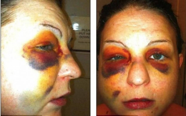 Φωτογραφίες-ΣΟΚ: Δείτε πως έγινε από την άγρια επίθεση του φίλου της