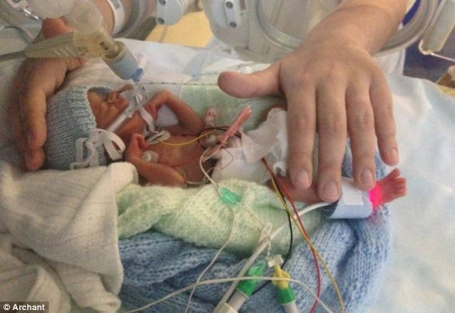 Θαύμα:Ζύγιζε όσο ένα σακουλάκι ζάχαρη και κατάφερε να κρατηθεί στη ζωή