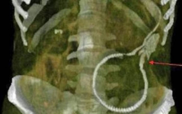 Σοκαρισμένοι οι γιατροί βρήκαν να κολυμπάει μέσα σε ασθενή ένα...