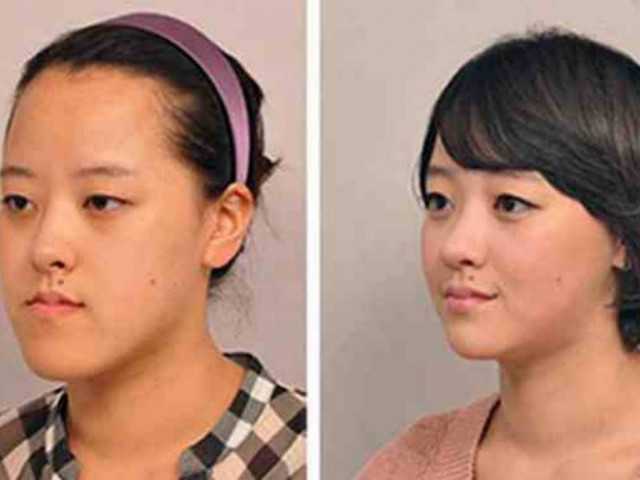 ΔΕΙΤΕ: Κορεάτες πριν και μετά την πλαστική