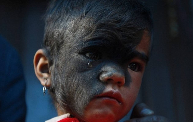 Η μεταμόρφωση της μικρής που έπασχε από το «σύνδρομο του λύκου»