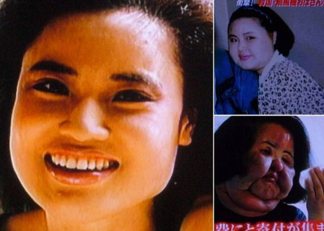 ΦΡΙΚΗ: Έκανε ενέσεις με λάδι στο πρόσωπό της-Δείτε πως παραμορφώθηκε