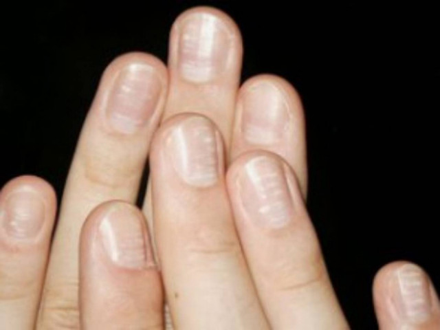 Σε ανησυχούν τα λευκά σημάδια στα νύχια σου; Δες τι συμβαίνει