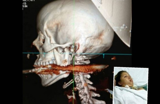 Την κάρφωσε κατά λάθος ο σύζυγός της με καμάκι στον αυχένα