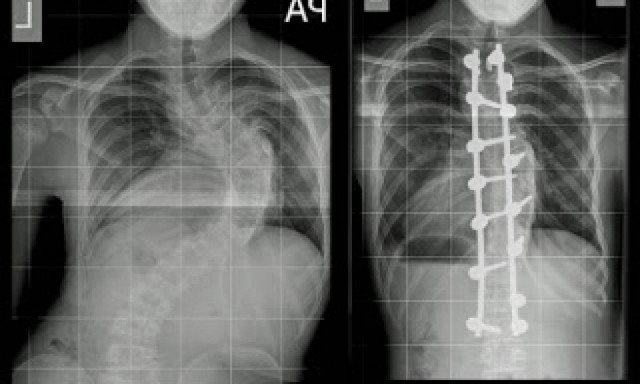 Έκανε εγχείρηση σκολίωσης και δείτε τι παθαίνει κάθε βράδυ