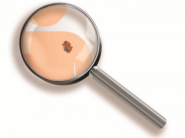 Μελάνωμα - Η έγκαιρη διάγνωση σώζει