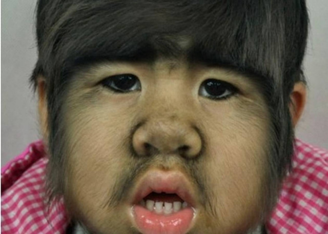 Το 4χρονο κοριτσάκι που πάσχει από το σύνδρομο του λυκανθρώπου (pics)