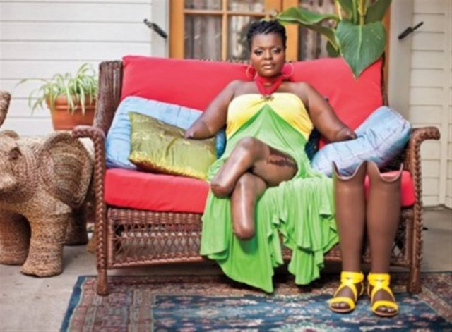 Γυναίκα ακρωτηριάστηκε σε χέρια και πόδια έπειτα από ενέσεις σιλικόνης