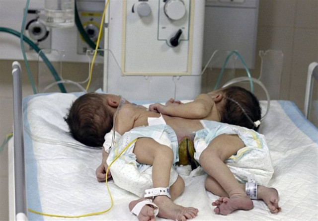 Γεννήθηκαν σιαμαία ενωμένα στην καρδιά!