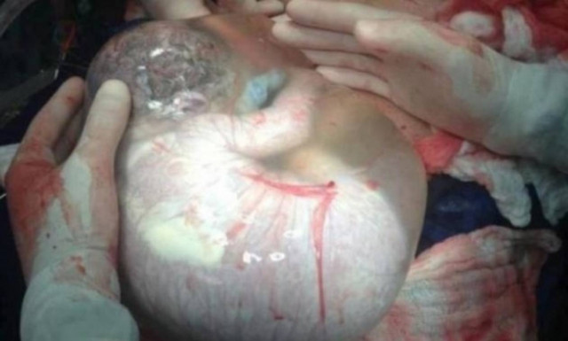 Η συγκλονιστική φωτογραφία μωρού μέσα στον αμνιακό σάκο