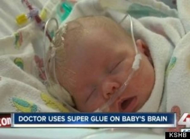 Έσωσαν τη ζωή ενός νεογέννητου μωρού με... κόλλα