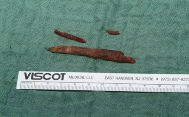 ΣΟΚ: Ζούσε για χρόνια με ένα μολύβι μέσα στο κεφάλι του