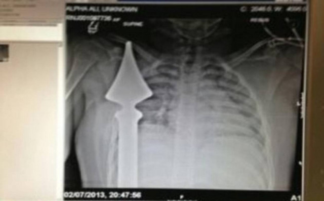 Ζει από θαύμα: Μαθητής καρφώθηκε σε μεταλλικό φράχτη