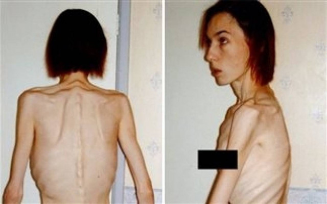 Είχε φτάσει μια ανάσα από το θάνατο αλλά νίκησε τη νευρική ανορεξία