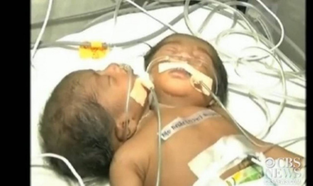 Δίνουν μάχη για να κρατήσουν στη ζωή μωρό με δύο κεφάλια