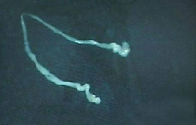 ΣΟΚ: Είχε πονοκέφαλο και ανακάλυψε ότι στο κεφάλι του ζούσε ένα...