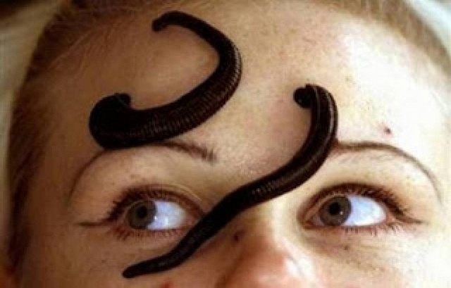 Απίστευτο: 385 βδέλλες της ξανακόλλησαν δέρμα