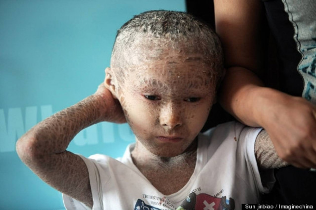 ΣΟΚ: Οκτάχρονος έχει δέρμα ίδιο με αυτό του ψαριού!