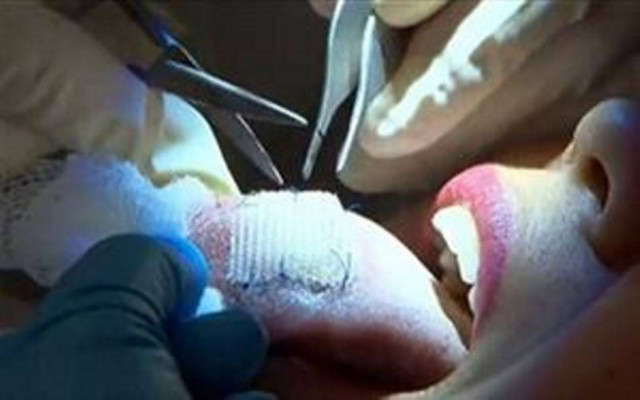 Επέμβαση στη γλώσσα για απώλεια βάρους