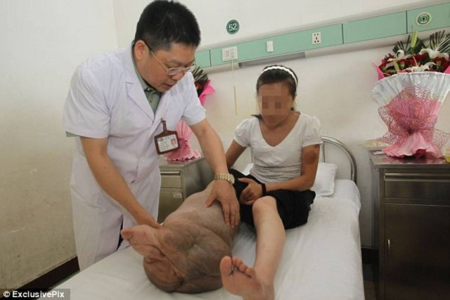 22χρονη ζούσε με έναν τεράστιο όγκο στο πόδι