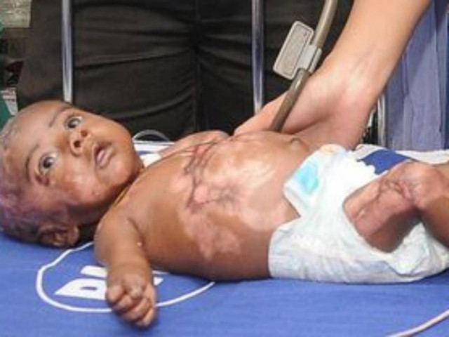 ΣΟΚ: Βρέφος πάσχει από «ανθρώπινη αυτανάφλεξη» (vid)