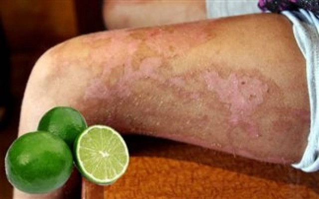 ΣΟΚ: Έπαθαν σοβαρά εγκαύματα εξαιτίας ενός... λάιμ