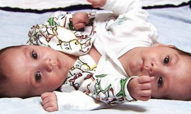 Τα σιαμαία που κέρδισαν τη ζωή και τώρα πηγαίνουν σχολείο! (pics)