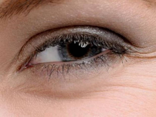 Γιατί δημιουργούνται οι «σακούλες» κάτω από τα μάτια