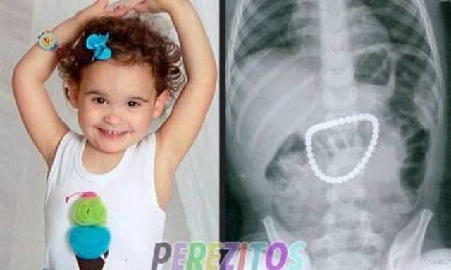 Τρίχρονο κοριτσάκι έφαγε κατά λάθος 37 μαγνητάκια!