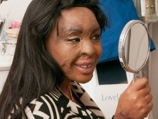 Το κατεστραμμένο πρόσωπο δεν πτοεί τη γενναία 21χρονη