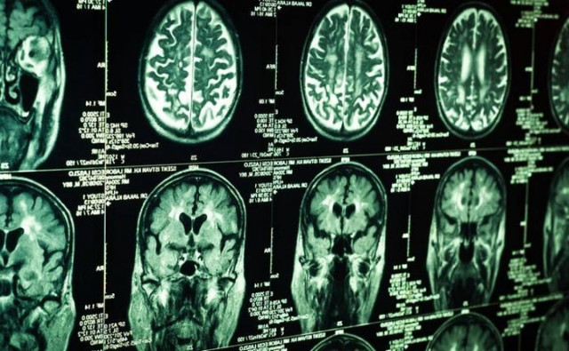 Μικρότερος ο εγκέφαλος παιδιών που οι μητέρες κάπνιζαν στην εγκυμοσύνη