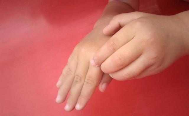 Τέλος η φαγούρα από τη δερματίτιδα, μια για πάντα!