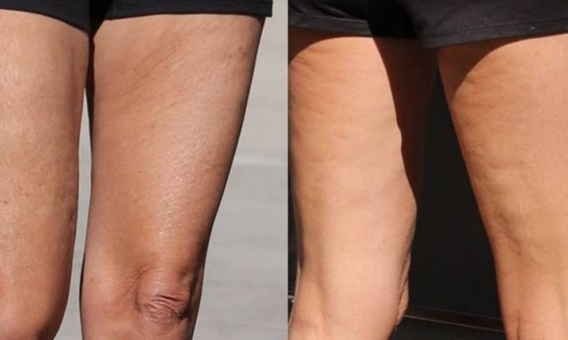 Έπεσαν να τη «φάνε» για την κυτταρίτιδα και την χαλάρωση στους μηρούς