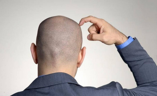 Πότε αρχίζουν να πέφτουν τα μαλλιά στους άνδρες
