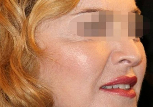 Διάσημη μαμά έκανε αυξητική ζυγωματικών για να δείχνει πιο νέα!