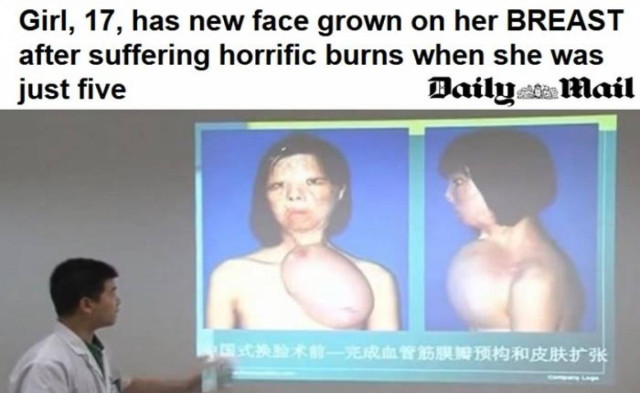 Κίνα: Δημιούργησαν νέο πρόσωπο στο στήθος 17χρονης
