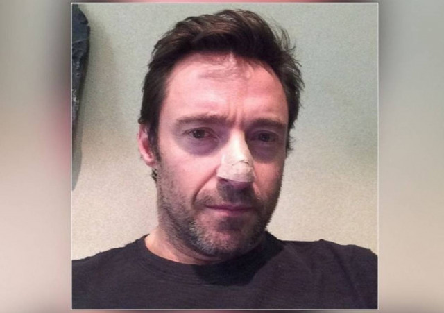 Ο Χιού Τζάκμαν φοβάται πως αντιμετωπίζει καρκίνο του δέρματος!