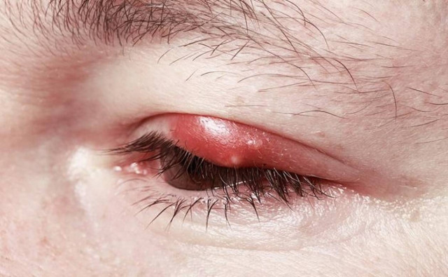 Κριθαράκι στο μάτι: Τι είναι και πώς αντιμετωπίζεται