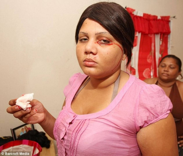 ΣΟΚ: 19χρονη κοπέλα όταν κλαίει αντί για δάκρυα βγάζει αίμα