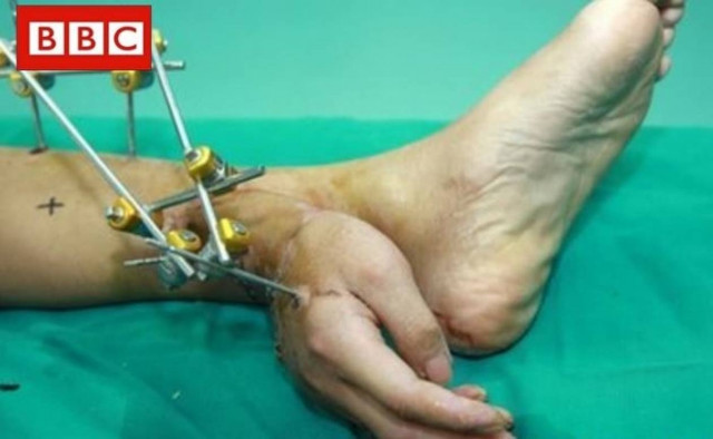 Κίνα: Έραψαν κομμένο χέρι στον αστράγαλο ασθενή για να το σώσουν