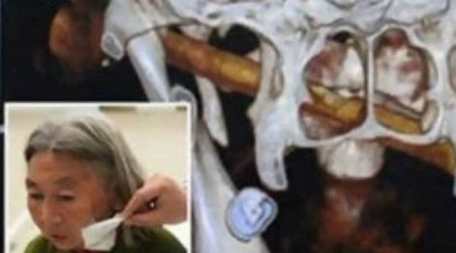 ΑΠΙΣΤΕΥΤΟ: Ζούσε για μήνες με ένα κομμάτι μπαμπού στο πρόσωπό της!