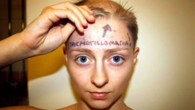 Το δράμα ενός κοριτσιού που ξεριζώνει μόνη της τα μαλλιά της