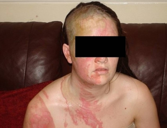 Της έριξε βραστό νερό γιατί δεν τον έκανε φίλο στο Facebook!