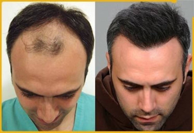 Βάλτε τέλος στη φαλάκρα!