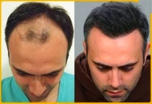 Βάλτε τέλος στη φαλάκρα!